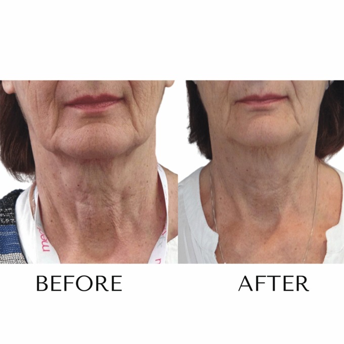 Crepe Skin Miracle Chin & Neck Firming Cream, , large