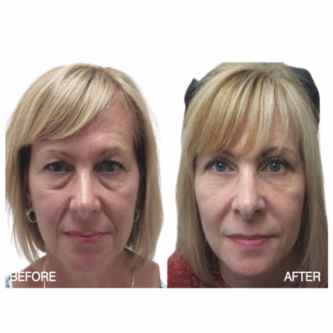 Puffy-Eye Cream, , large