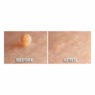 Skin Perfect Skin Tag & Wart Remover&nbsp;, , large