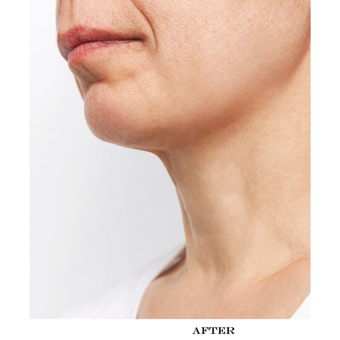 6-Pack Skin Firming Collagen & Hyaluronic Acid Chin Masks, , large