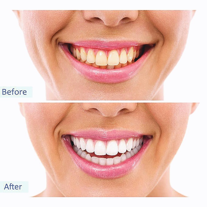 Rechargeable Sonic Plaque Remover, , large