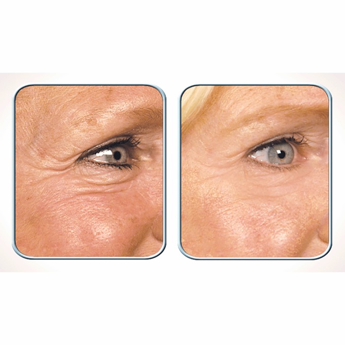 Stem Cell Therapy, , large